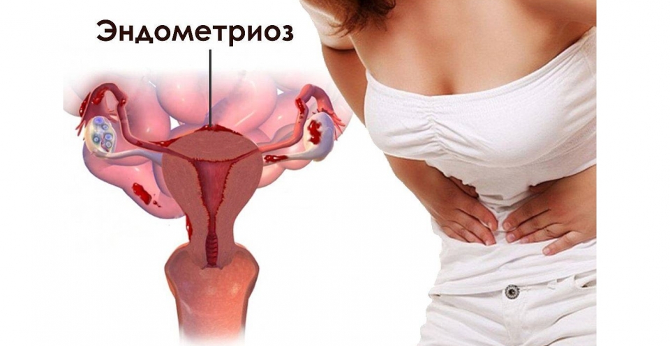 Что такое эндометриоз кишечника?