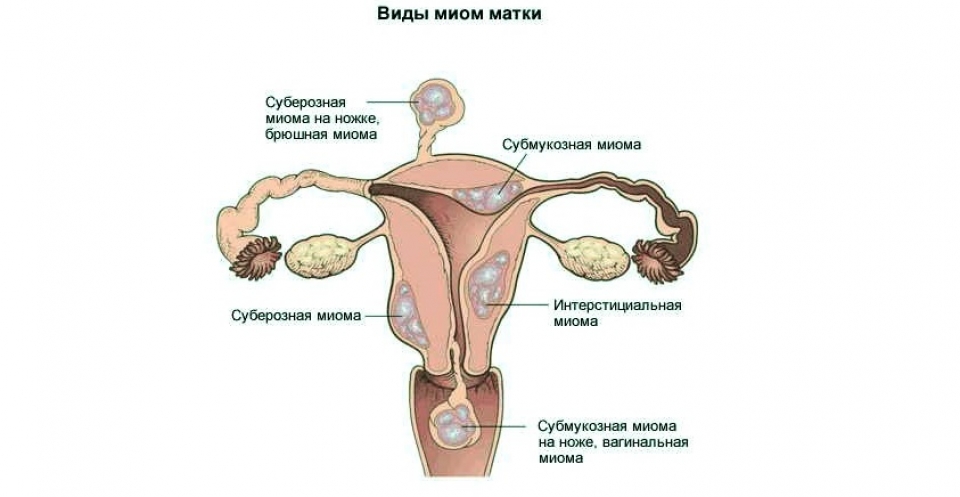 Диагностика рака матки